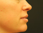 Juvederm