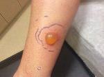 Scar Treatment