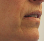Laser Skin Resurfacing