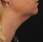 CoolSculpting