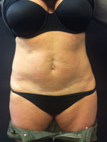 CoolSculpting