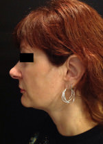 Exilis