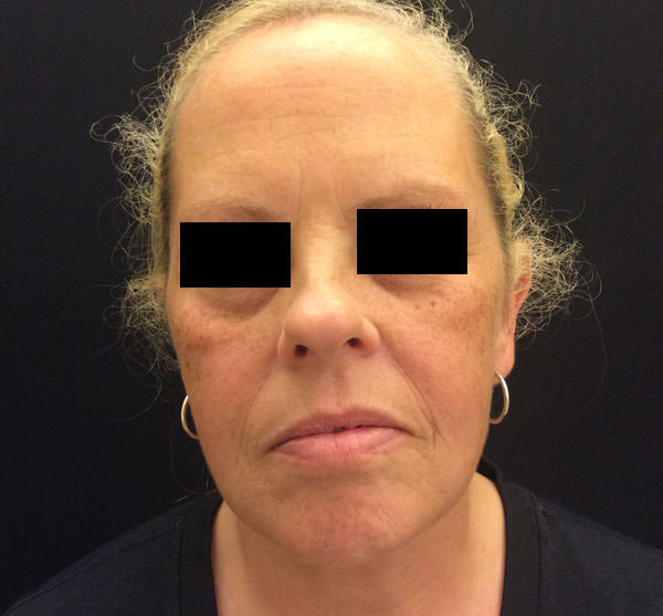 Exilis