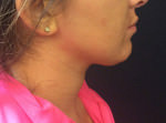 Liposuction Under Chin