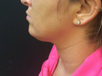 Liposuction Under Chin