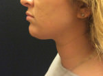Liposuction Under Chin
