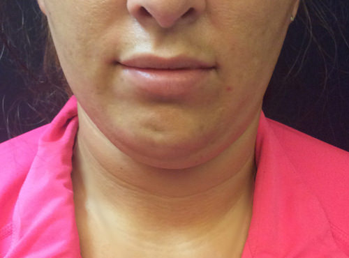 Liposuction Under Chin