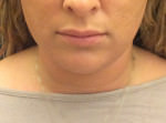 Liposuction Under Chin