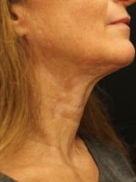 Chemical Peels