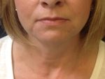 Juvederm