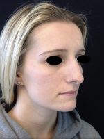 Nose Surgery