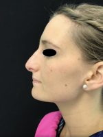 Nose Surgery