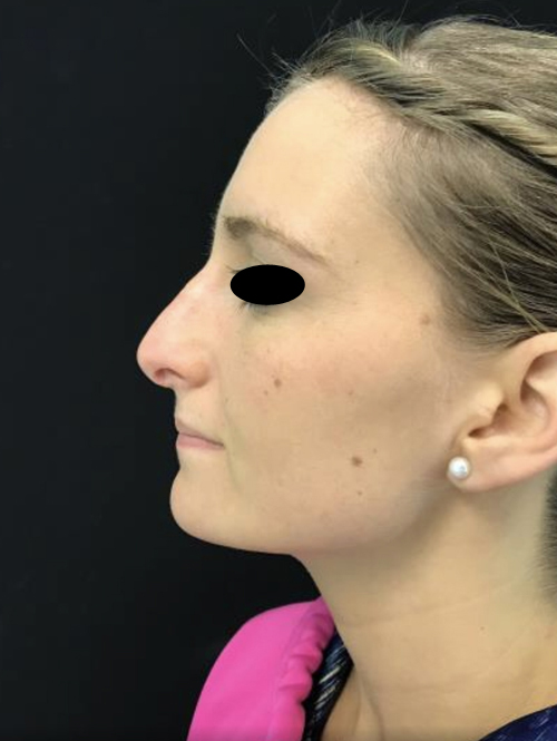 Nose Surgery