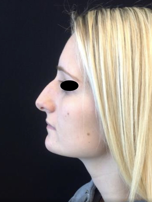 Nose Surgery
