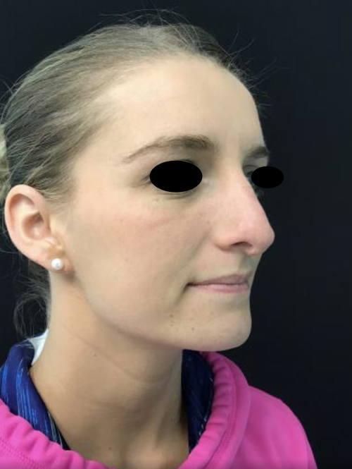 Nose Surgery