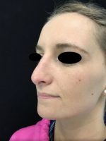 Nose Surgery