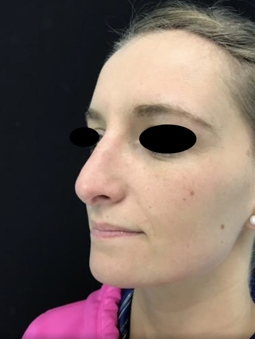 Nose Surgery