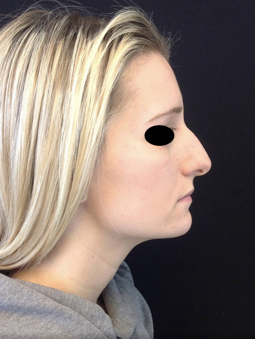 Nose Surgery
