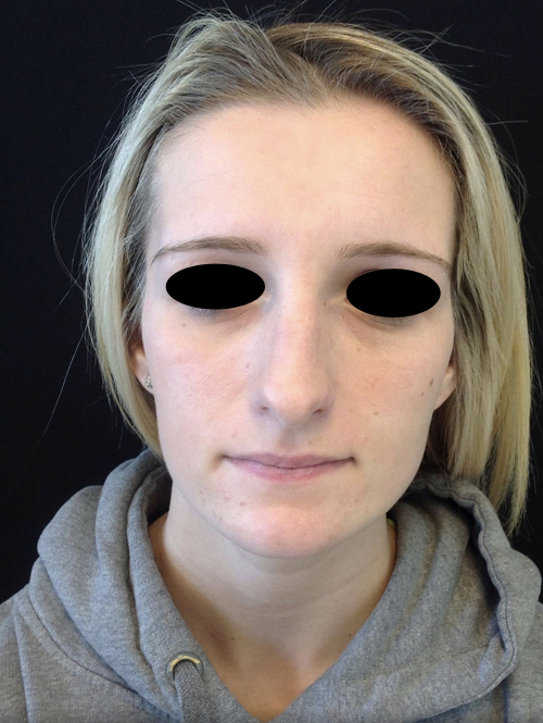 Nose Surgery