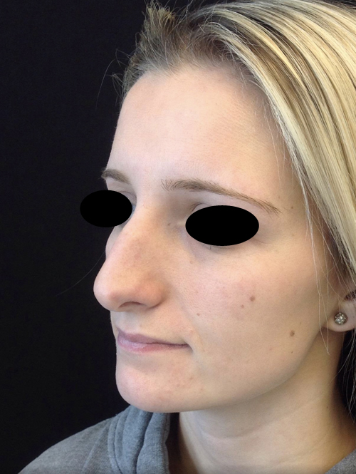 Nose Surgery