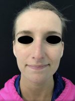 Nose Surgery