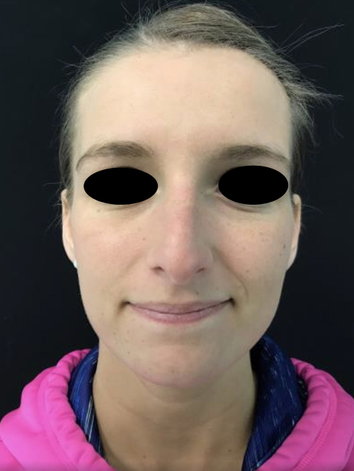Nose Surgery