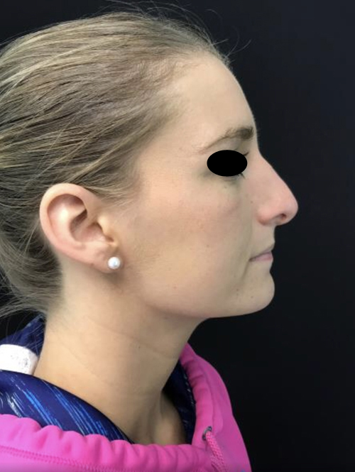 Nose Surgery
