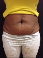CoolSculpting