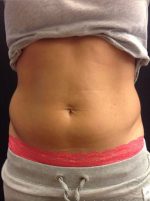 CoolSculpting
