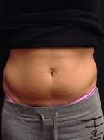 CoolSculpting