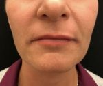 Juvederm
