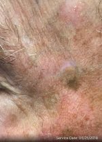 Actinic Keratoses