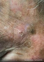 Actinic Keratoses