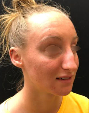 Nasal Reconstruction