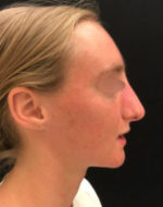 Nasal Reconstruction