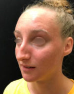 Nasal Reconstruction