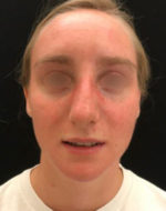 Nasal Reconstruction