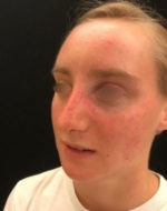 Nasal Reconstruction