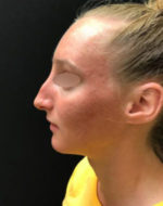 Nasal Reconstruction