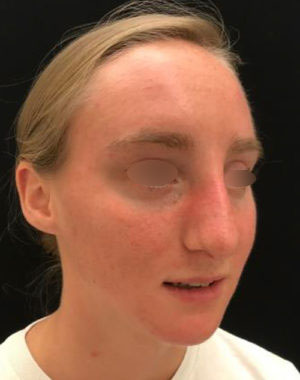 Nasal Reconstruction