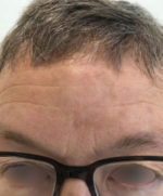 Actinic Keratoses