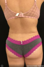 Brazilian Butt Lift