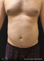 Smartlipo