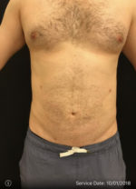 Smartlipo