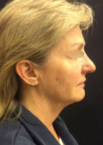 Incisionless Necklifts