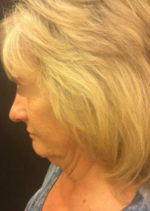 Incisionless Necklifts
