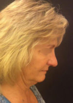 Incisionless Necklifts