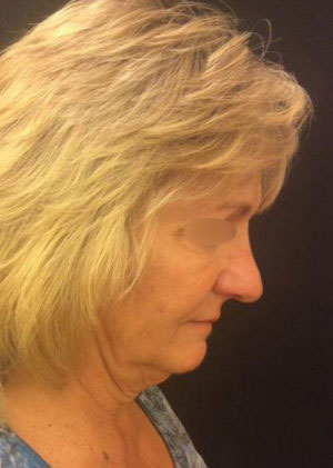 Incisionless Necklifts