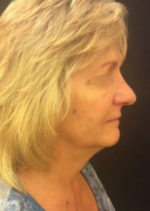 Incisionless Necklifts