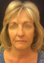 Incisionless Necklifts